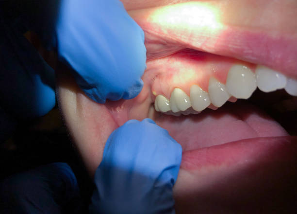 Best Emergency Dentist for Knocked-Out Tooth in Fife, WA